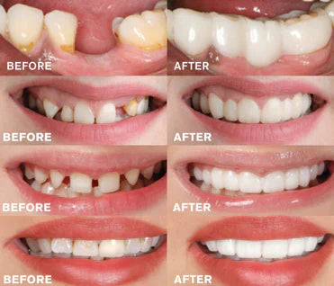 Comfortabele klikprothese voor een stralende glimlach – BRIGHTBITE EASY - Glamorix